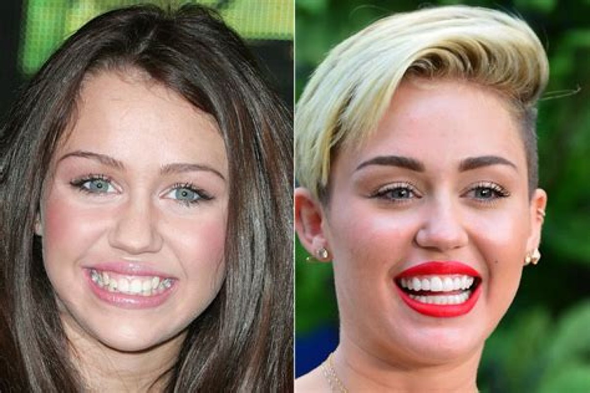 Celebrity Teeth Before & After: Dental Whitening Makeovers