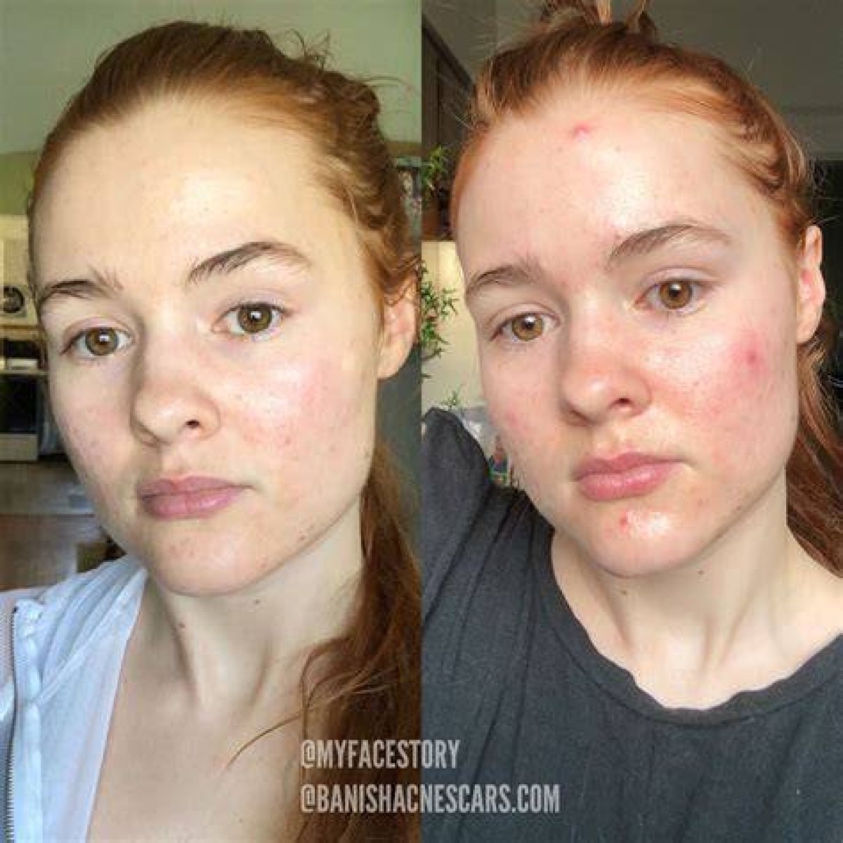 Microneedling Ruined My Skin: a Cautionary Tale