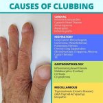 Understanding Clubitis Disease Symptoms in Adults: a Comprehensive Guide